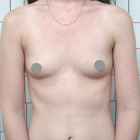 Necesidad de Implantes mamarios