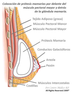 Colocación de prótesis mamarias por delante del músculo pectoral mayor