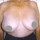 Necesidad de Reducción de mamas con levantamiento de senos