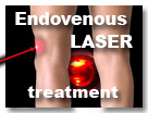 Endovenous Laser