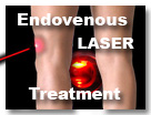 Endovenous Laser