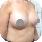 After Breast Implant