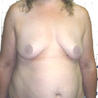 Before Breast Implant