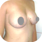 After Breast Implant