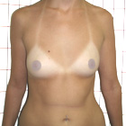 Before Breast Implant