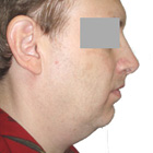 Before Chin Implant
