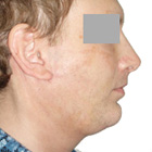 After Chin Implant