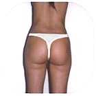After Liposuction