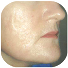 After Deep Chemical Peel