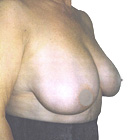 Before Breast Lift