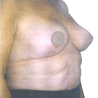 After  Breast Reduction