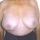 Before  Breast Reduction