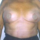 After  Breast Reduction